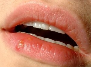 Herpes labialis-Fuente: wikipedia